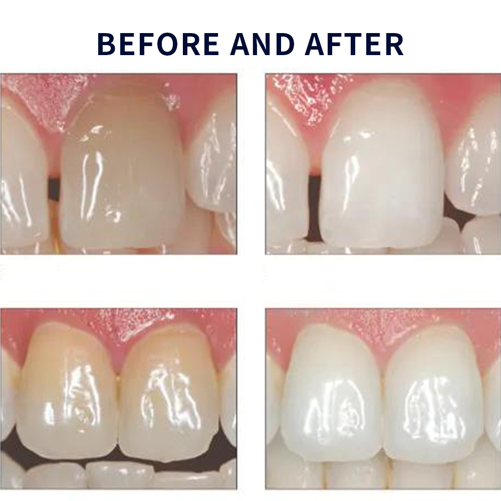Opalescence beyazlatma 20% PF  - Teeth Whitening Bleaching Kit incelemesi ve fiyatı