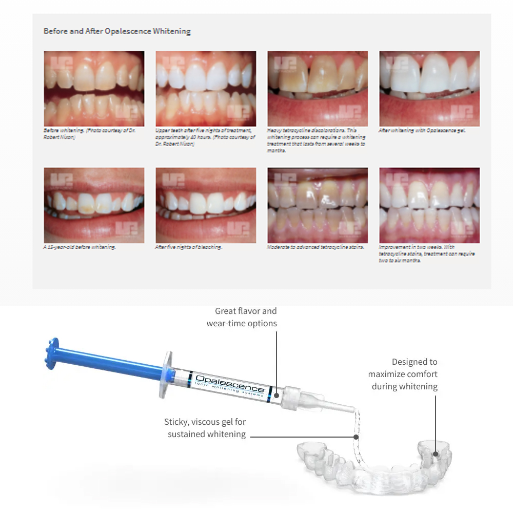 Opalescence beyazlatma 20% PF  - Teeth Whitening Bleaching Kit incelemesi ve fiyatı
