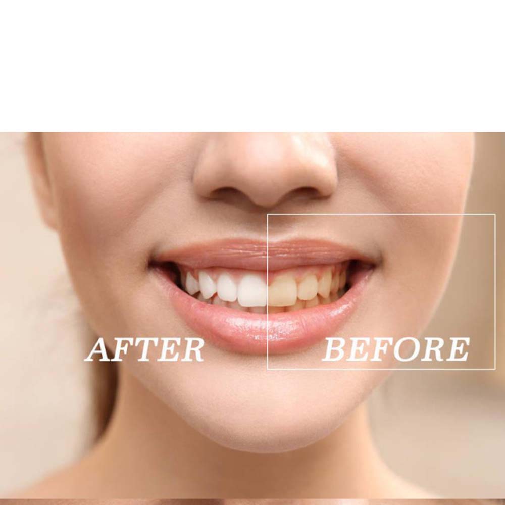 En kaliteli peroksit diş beyaz - Teeth Whitening Bleaching Kit incelemesi ve fiyatı