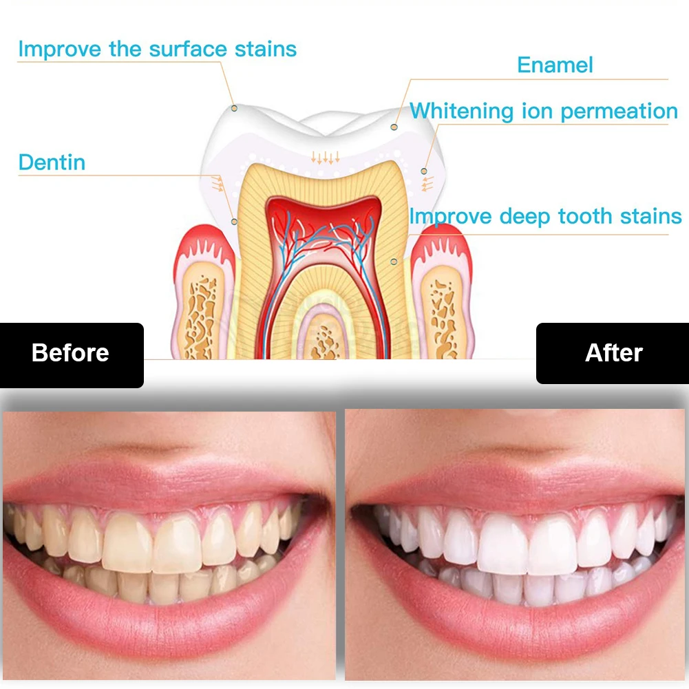 Diş Diş Beyazlatma Kiti Mini 1 - Teeth Whitening Bleaching Kit incelemesi ve fiyatı