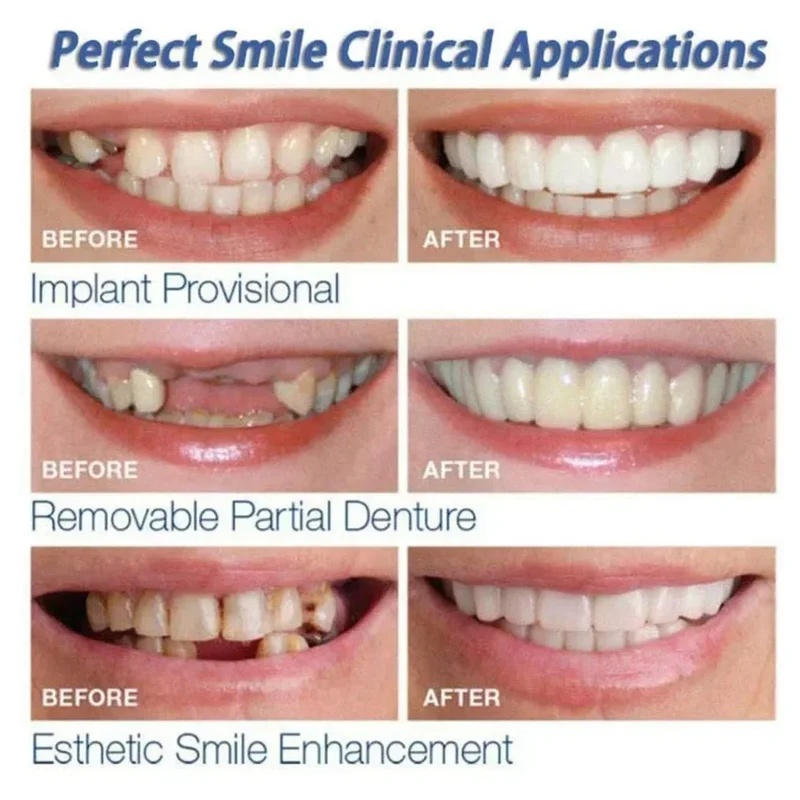 Çıkarılabilir Kaplama Diş Seti - Teeth Whitening Veneers incelemesi ve fiyatı